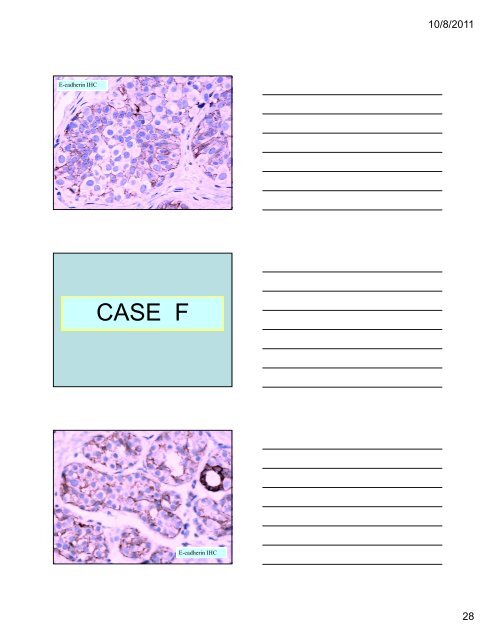 33 Special Types of Invasive Breast Carcinoma: Diagnostic Criteria ...