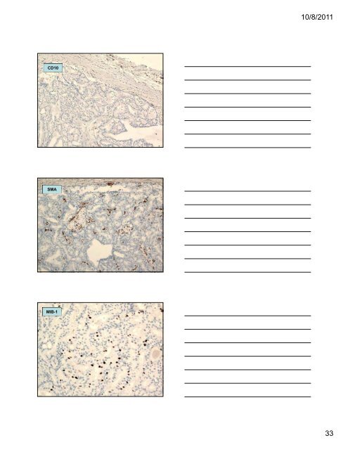 33 Special Types of Invasive Breast Carcinoma: Diagnostic Criteria ...