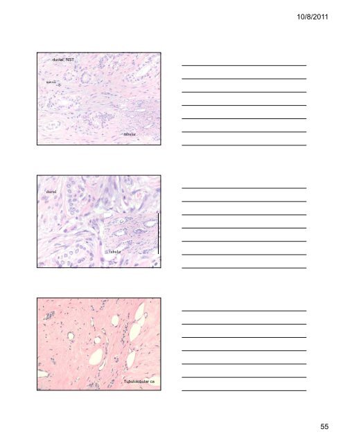 33 Special Types of Invasive Breast Carcinoma: Diagnostic Criteria ...