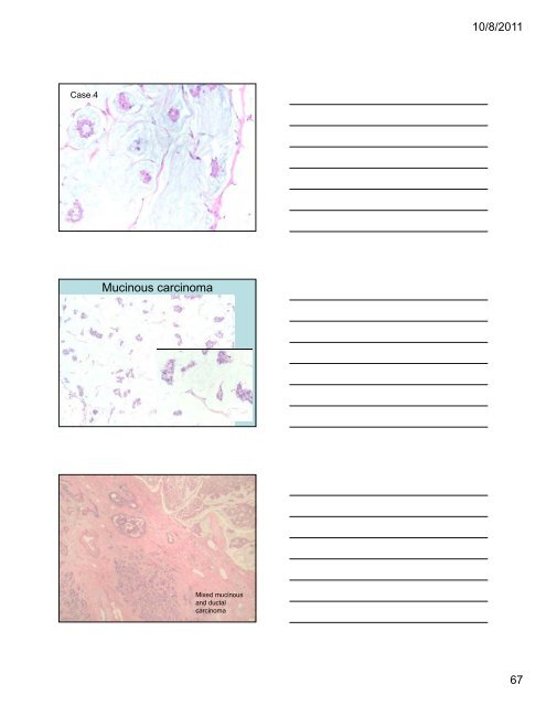 33 Special Types of Invasive Breast Carcinoma: Diagnostic Criteria ...