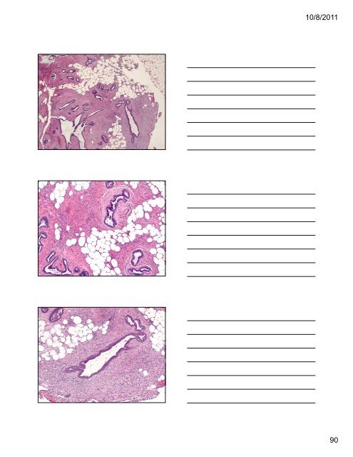 33 Special Types of Invasive Breast Carcinoma: Diagnostic Criteria ...