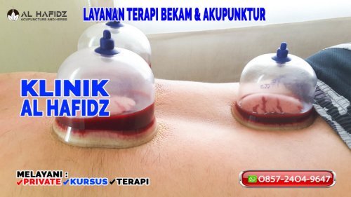0857-2404-9647 Klinik Pengobatan Terapi Bekam Di Purwakarta