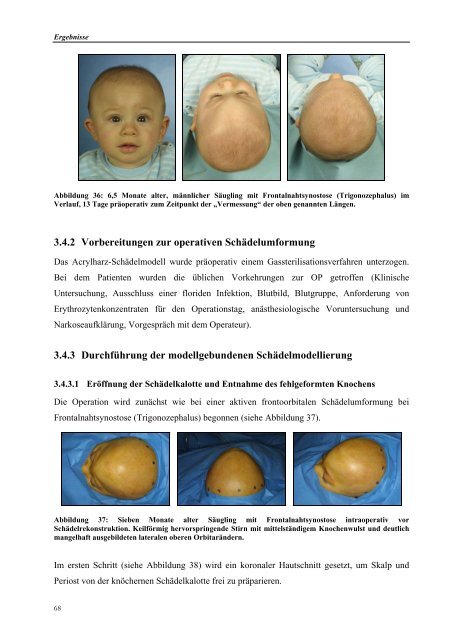 DISSERTATION Modellgebundene Cranioplastie ... - ZIB