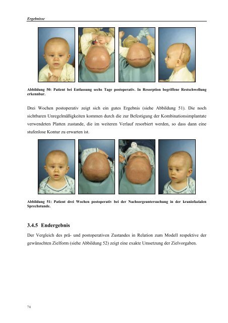 DISSERTATION Modellgebundene Cranioplastie ... - ZIB