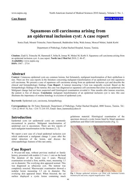 Squamous cell carcinoma arising from an epidermal inclusion cyst ...