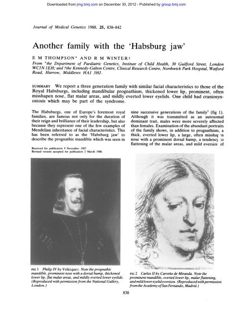 Habsburg jaw: mandibular prognathism