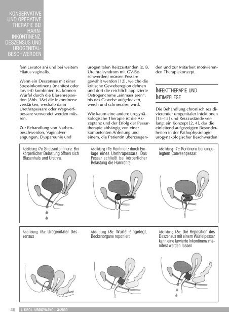 konservative und operative therapie bei harninkontinenz, deszensus ...