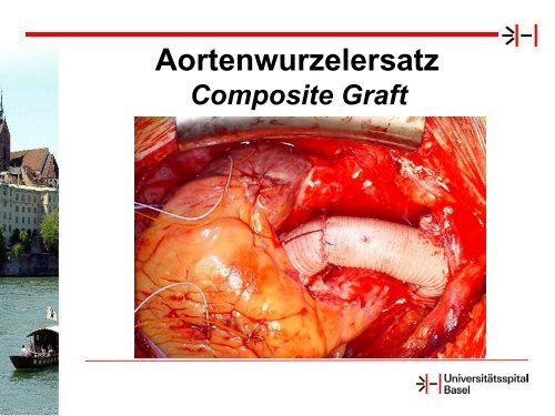 Schurr: Chirurgischer Aortenklappenersatz