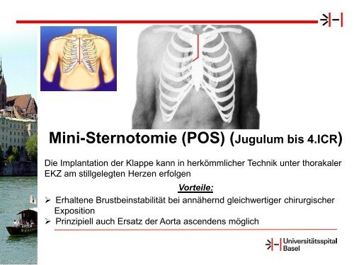 Schurr: Chirurgischer Aortenklappenersatz