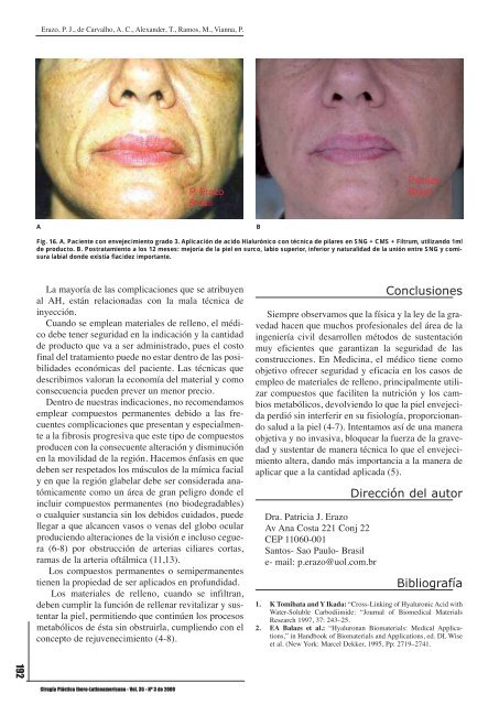 Relleno facial con ácido hialurónico: técnica de pilares y malla de ...