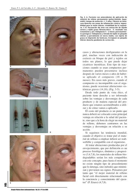 Relleno facial con ácido hialurónico: técnica de pilares y malla de ...