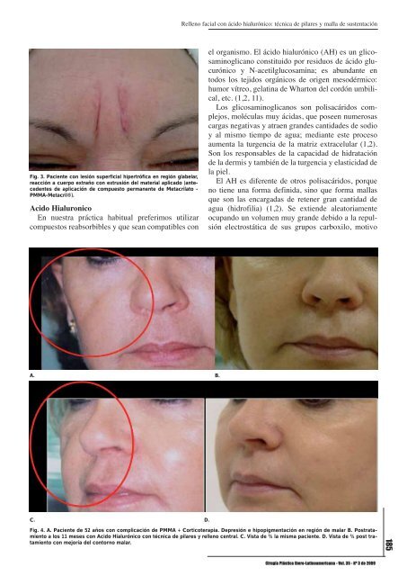 Relleno facial con ácido hialurónico: técnica de pilares y malla de ...