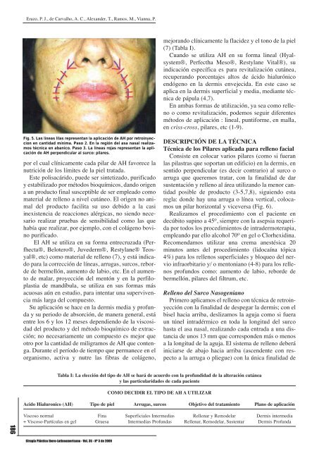 Relleno facial con ácido hialurónico: técnica de pilares y malla de ...