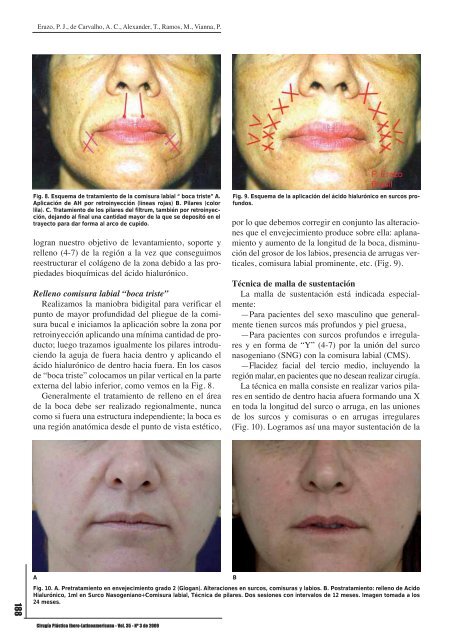 Relleno facial con ácido hialurónico: técnica de pilares y malla de ...