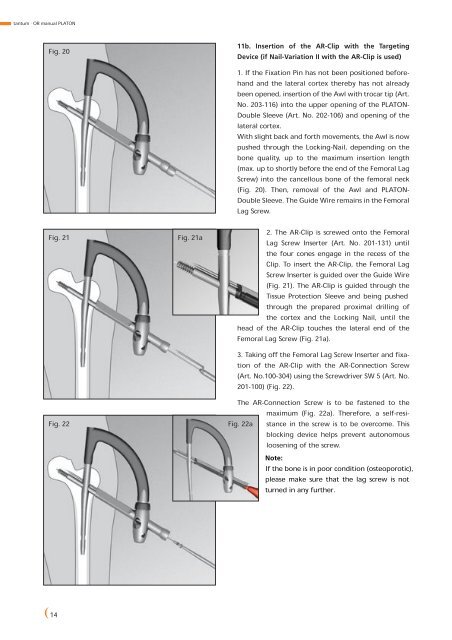 PLATON-Locking-Nail-System - tantum AG