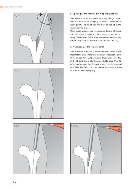 PLATON-Locking-Nail-System - tantum AG