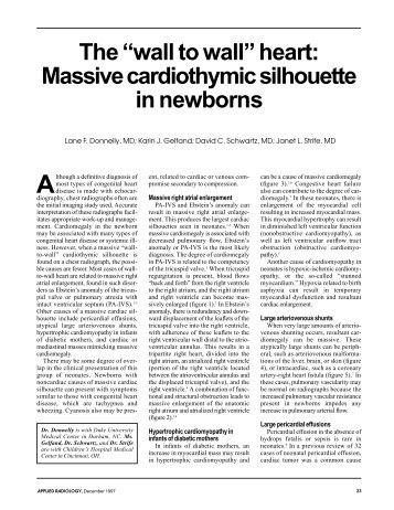 The “wall to wall” heart: Massive cardiothymic silhouette in newborns
