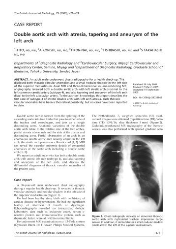 Double aortic arch with atresia, tapering and aneurysm of the left arch