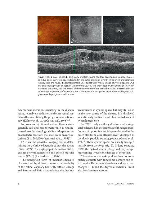 Macular Edema: Definition and Basic Concepts - Karger