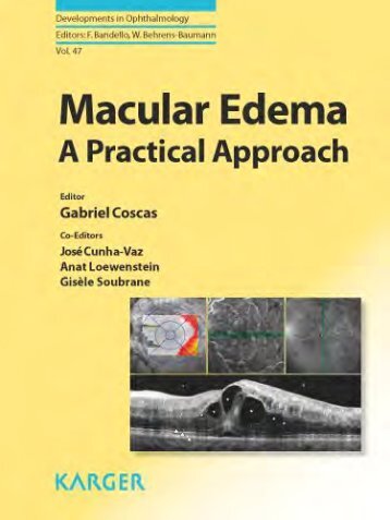 Macular Edema A Practical Approach