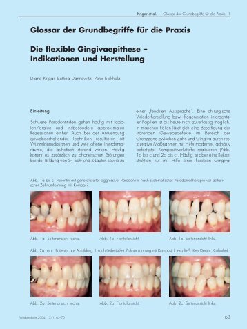 Glossar der Grundbegriffe für die Praxis Die flexible Gingivaepithese