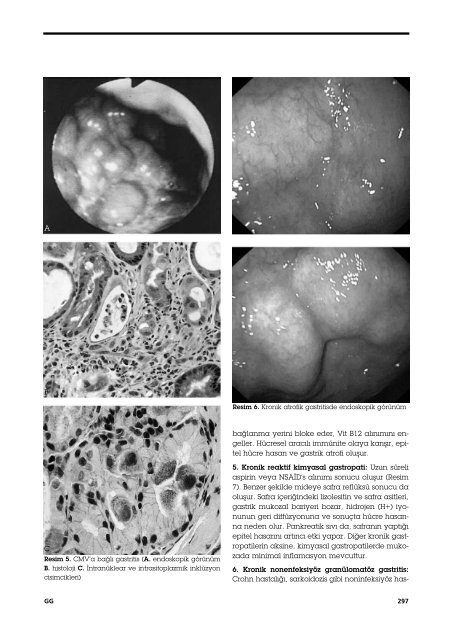 Akut ve Kronik Gastritisler - Güncel Gastroenteroloji