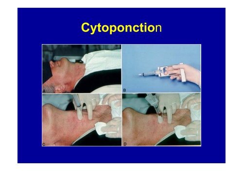 Conduite du diagnostic devant un goitre