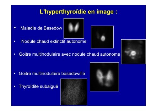 Conduite du diagnostic devant un goitre