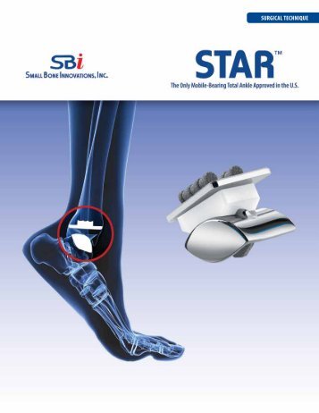 STAR Surgical Technique - Small Bone Innovations