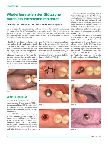 Wiederherstellen der Stützzone durch ein Einzelzahnimplantat