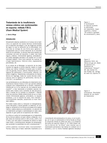 Tratamiento de la insuficiencia venosa crónica con esclerosantes en ...