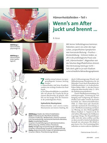 HÃ¤morrhoidalleiden â Teil 1 Wenn's am After juckt und brennt