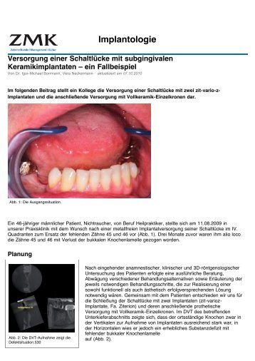 Versorgung einer Schaltlücke mit subgingivalen Keramikimplantaten