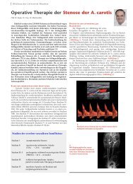 Operative Therapie der Stenose der A. carotis - Einblicke