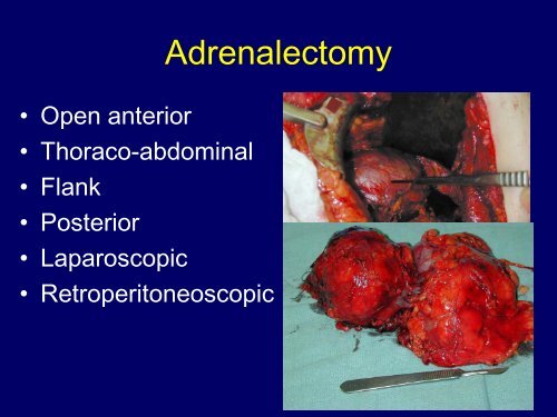 Pheochromocytoma - University of Colorado Denver