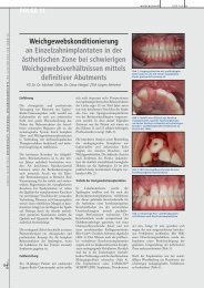 Weichgewebskonditionierung an ... - Alltec Dental