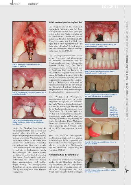 Weichgewebskonditionierung an ... - Alltec Dental