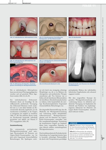 Weichgewebskonditionierung an ... - Alltec Dental