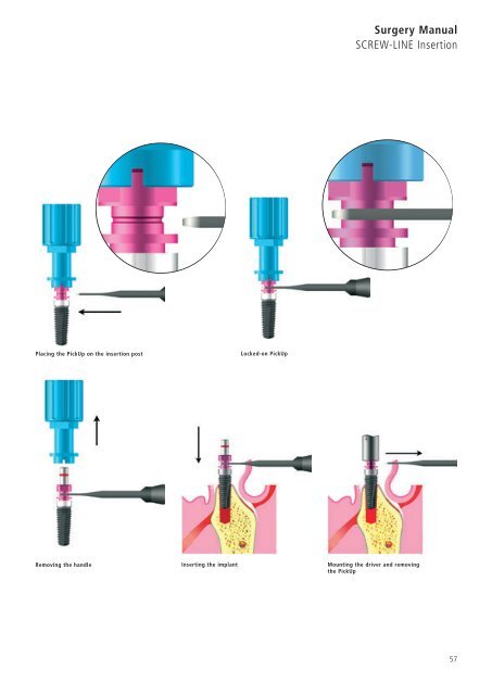 1 Surgery CAMLOG Compendium