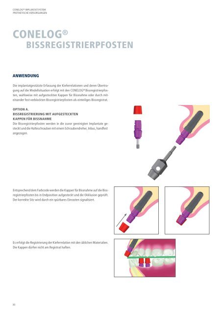 CONELOG® Implantatsystem Prothetische Versorgungen - Camlog