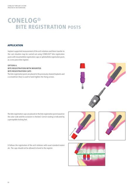 CONELOG® Implant System Prosthetic Restorations - Camlog