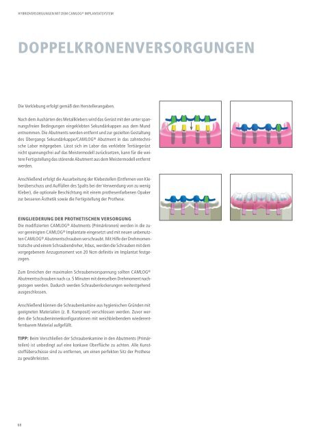 Hybridversorgungen mit dem CAMLOG Implantatsystem (PDF, 7 ...