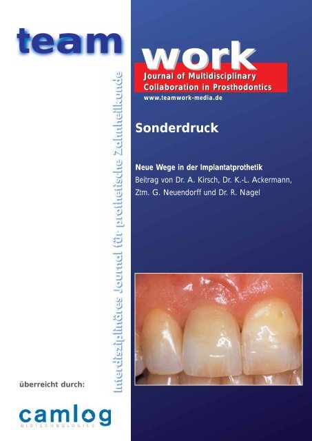 Sonderdruck Neue Wege in der Implantatprothetik - Alltec Dental