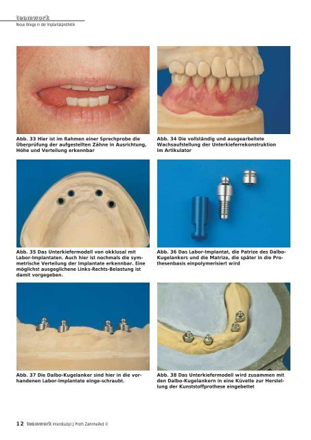 Sonderdruck Neue Wege in der Implantatprothetik - Alltec Dental