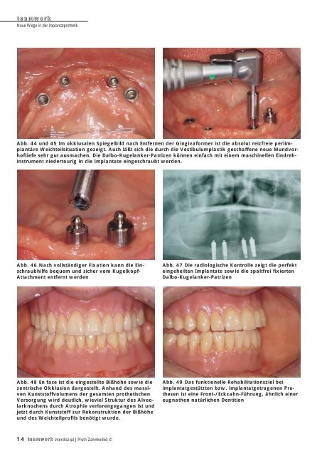 Sonderdruck Neue Wege in der Implantatprothetik - Alltec Dental