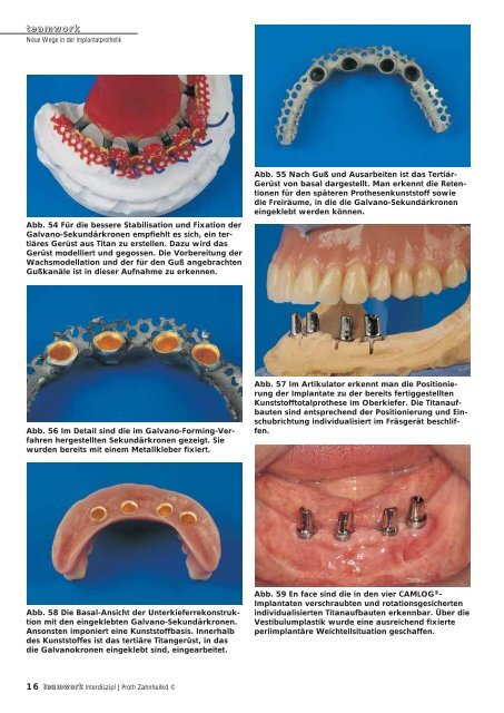 Sonderdruck Neue Wege in der Implantatprothetik - Alltec Dental