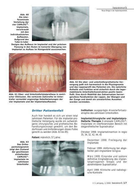 Sonderdruck Neue Wege in der Implantatprothetik - Alltec Dental