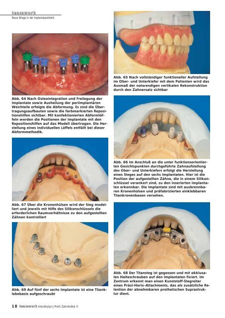 Sonderdruck Neue Wege in der Implantatprothetik - Alltec Dental