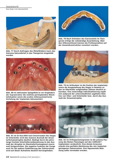 Sonderdruck Neue Wege in der Implantatprothetik - Alltec Dental