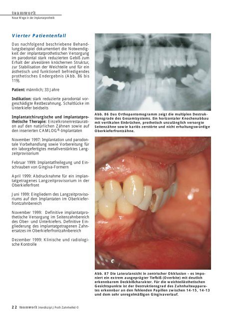 Sonderdruck Neue Wege in der Implantatprothetik - Alltec Dental